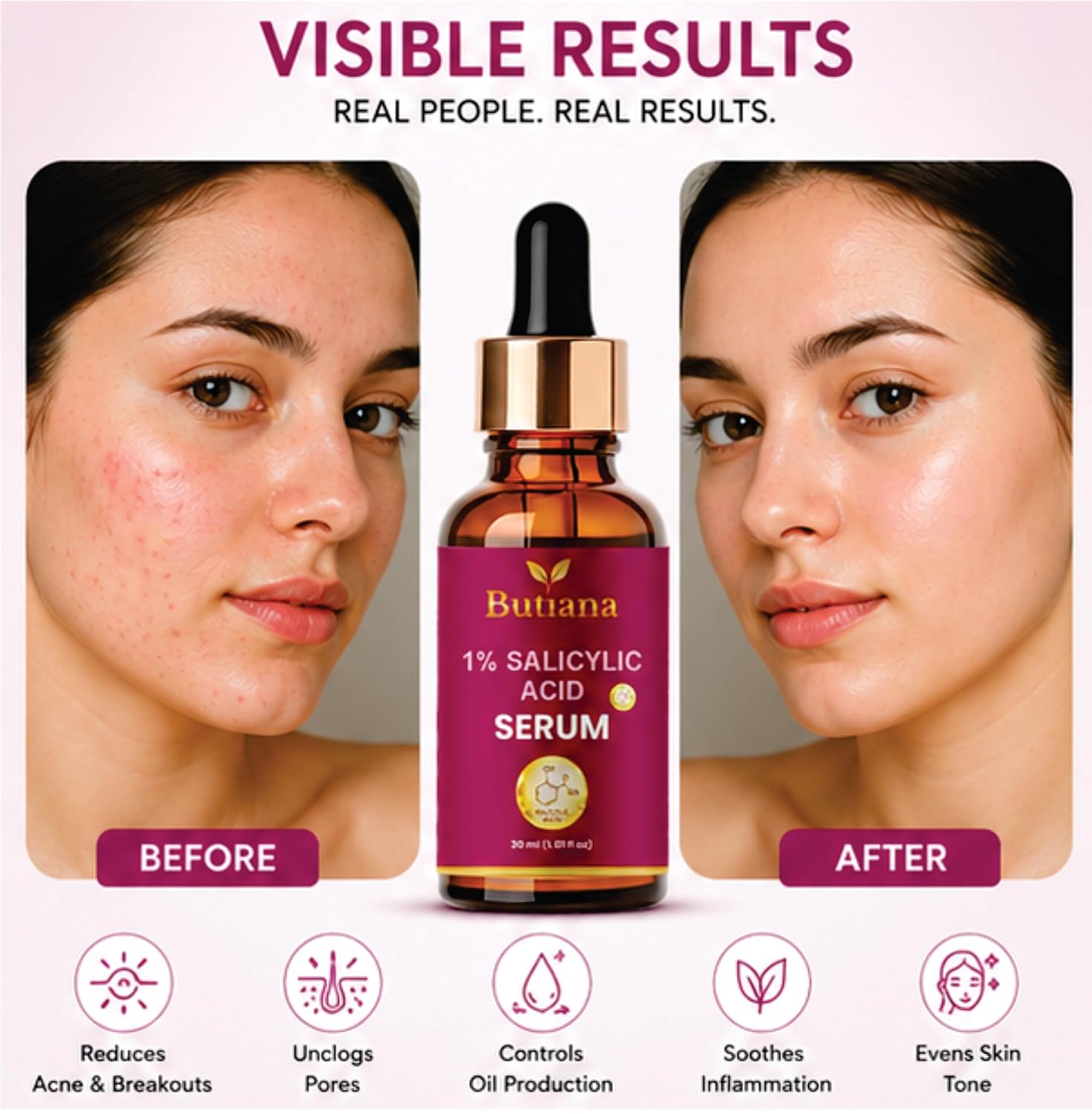 Butiana 1% Salicylic Acid Face Serum 30ml – Acne Control, Oil Balance, Pore Minimizing, Blackhead Removal, Gentle Exfoliation for Clear, Smooth & Healthy Skin